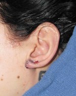 After Earlobe Surgery