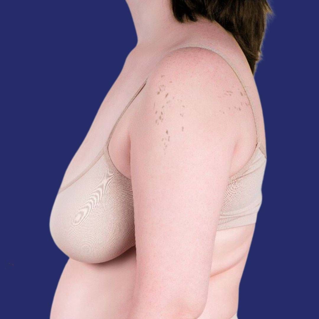 Mastopexy without implants before and after