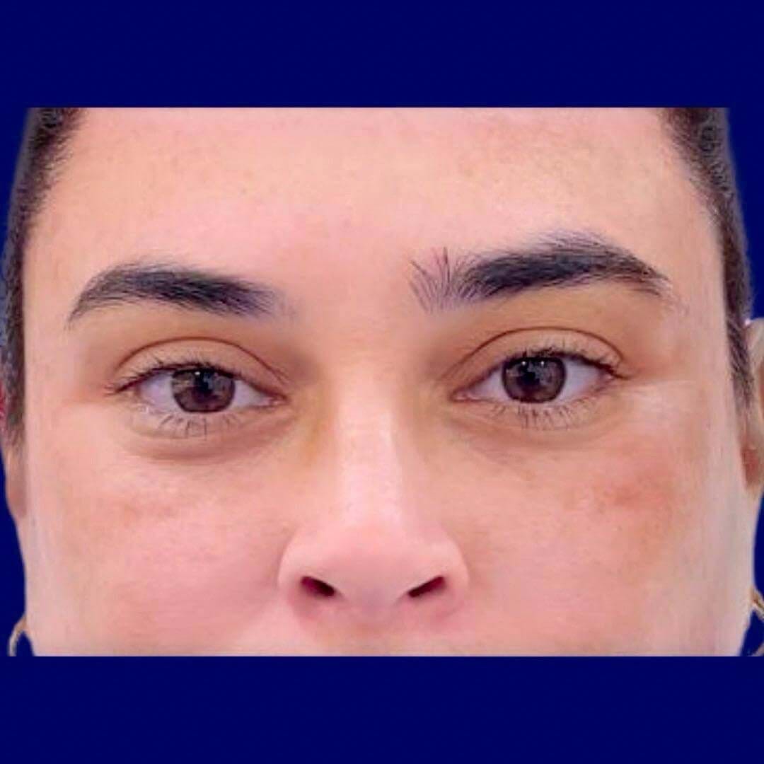 Close-up photo of droopy eyebrows before the brow lift procedure