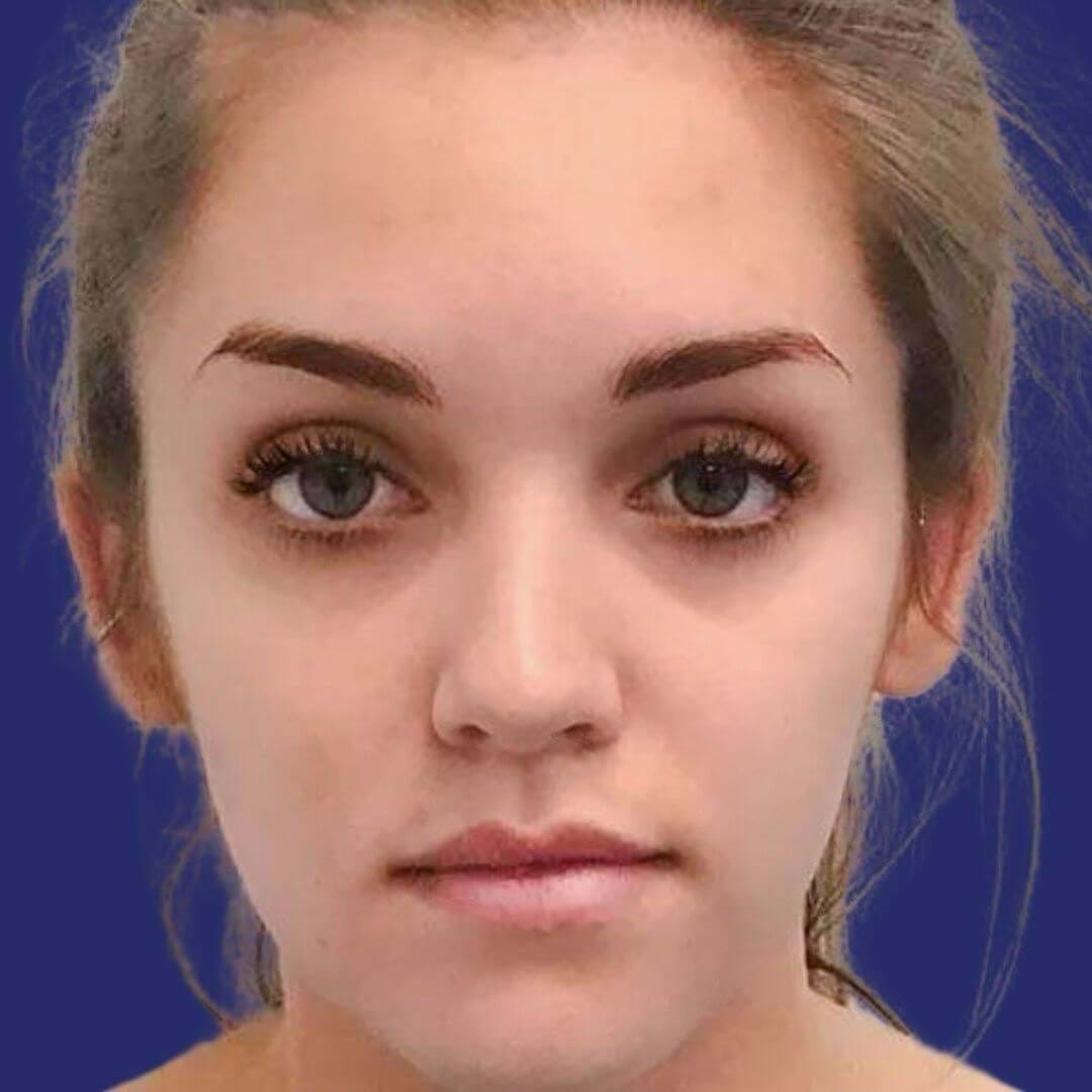 Photograph highlighting uneven eyebrow alignment prior to brow lift procedure