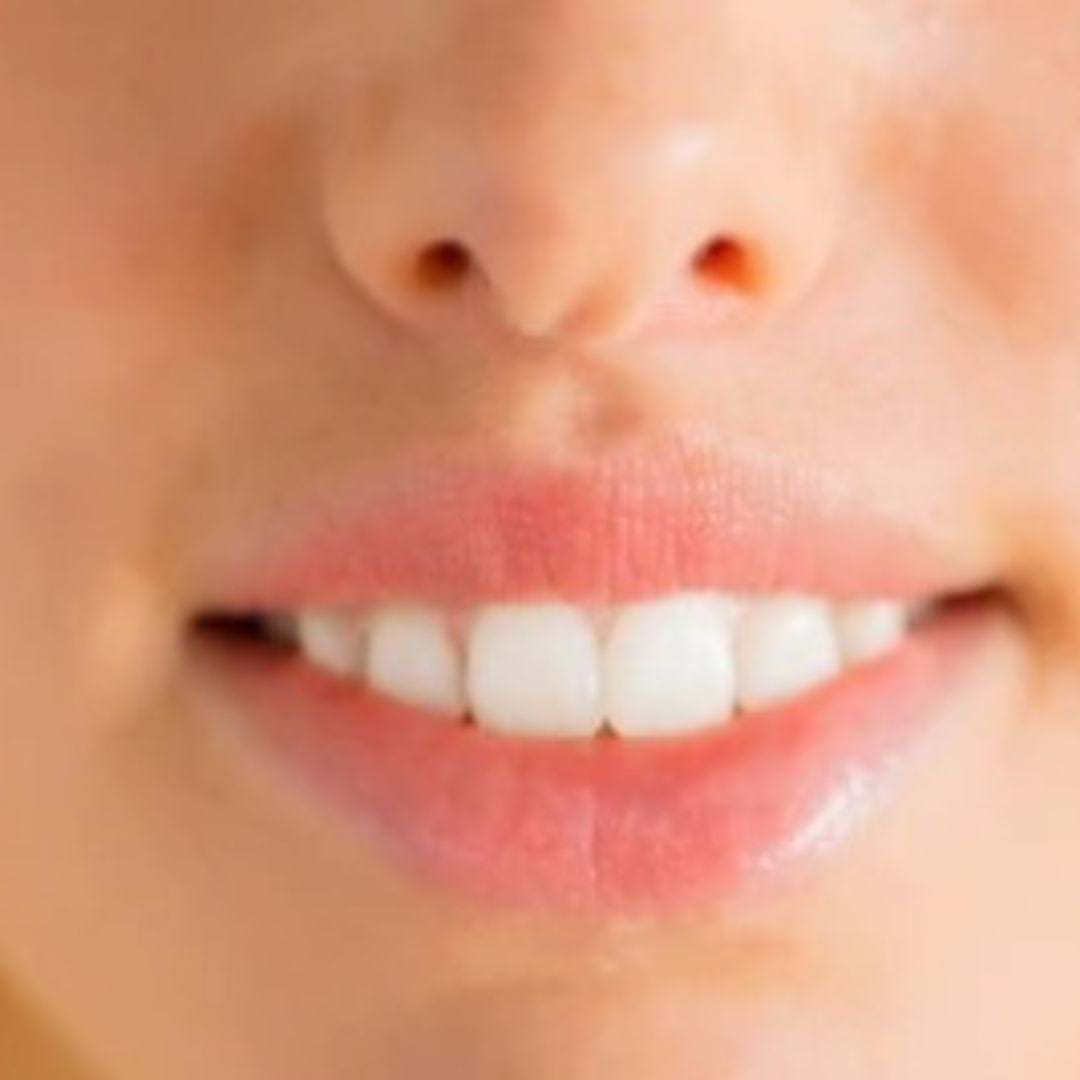 Frontales Bild des Gesichts nach der Lip-Lift-Operation, mit einem strahlenden Lächeln 