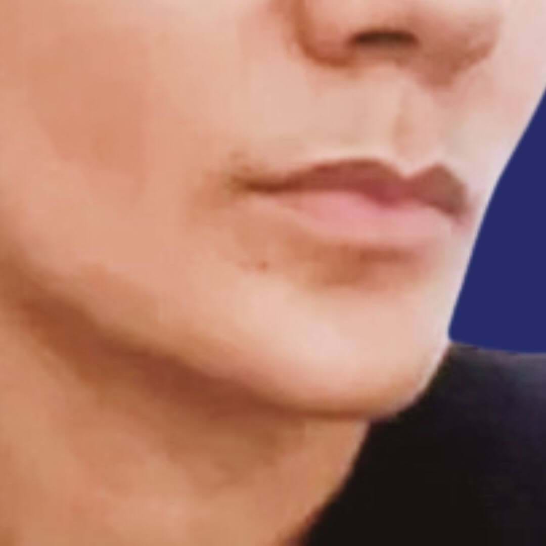 Dreiviertelansicht des Gesichts vor der Lip-Lift, die Lippen im Ruhezustand zeigt.