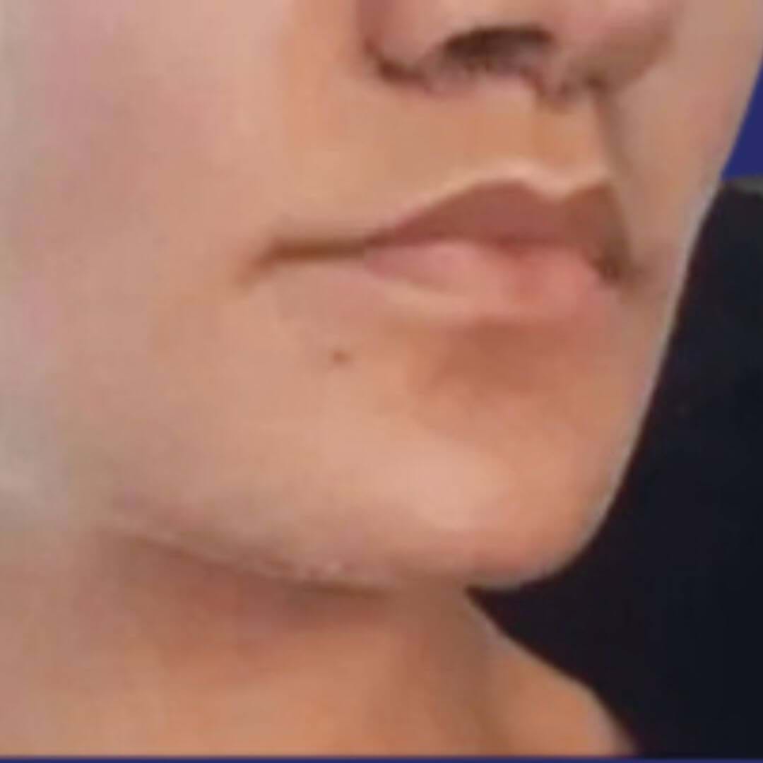 Dreiviertelansicht des Gesichts nach der Lip-Lift, die eine verbesserte Gesichtsharmonie und definiertere Lippen zeigt.