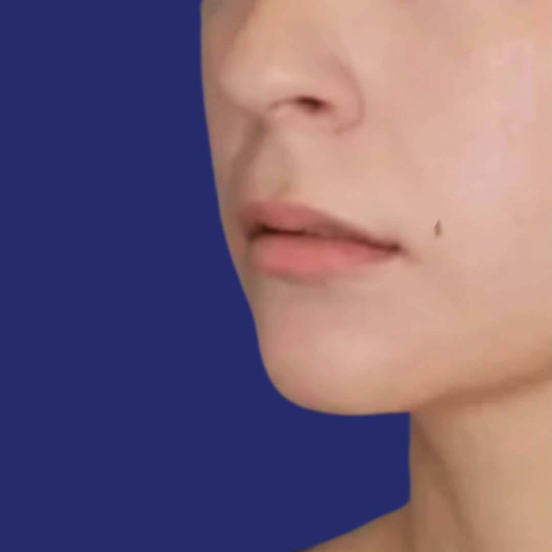 Vorher: Nahaufnahme von Lippen vor dem Lip-Lift