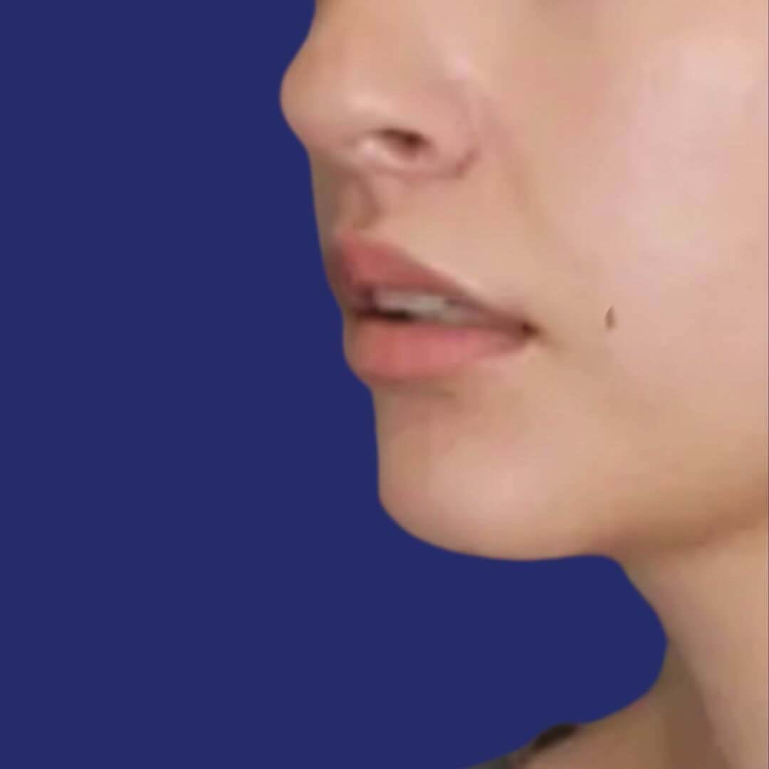 Nachher: Nahaufnahme von Lippen nach dem Lip-Lift, die ein erhöhtes Volumen und eine verbesserte Definition der Oberlippe zeigt.