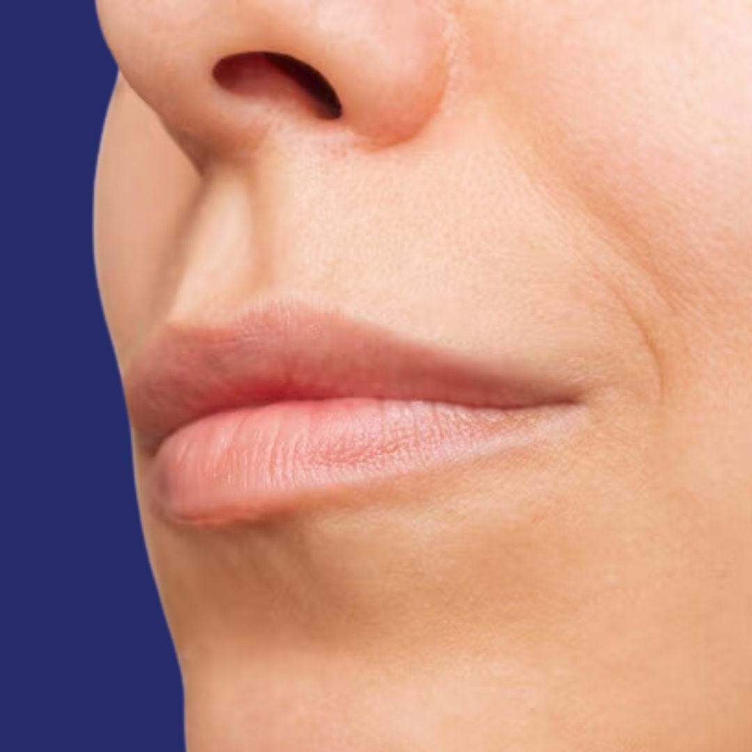Profilfoto des Gesichts vor der Lippenvergrößerung mit Füllern