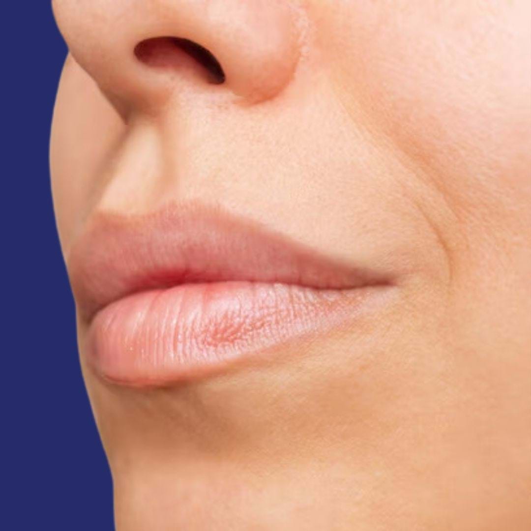 Profilansicht des Gesichts nach dem Lippenvergrößerung mit Füllern