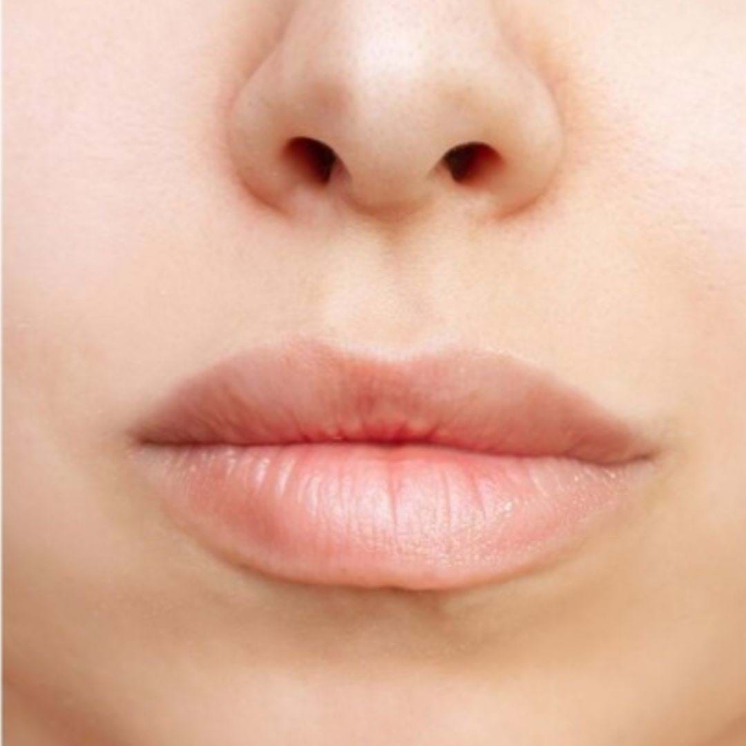 Frontales Bild des Gesichts nach der  Lippenvergrößerung mit Füllern