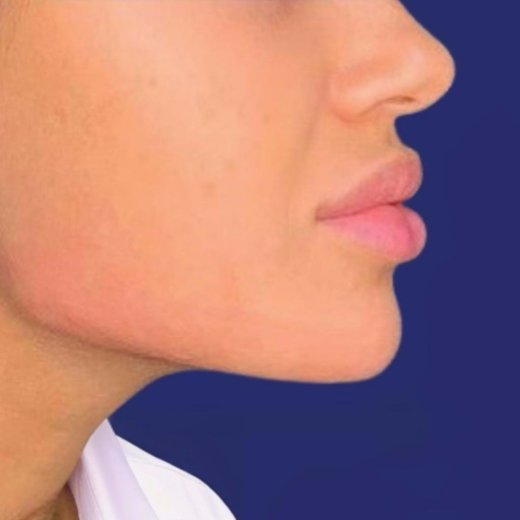 Lip-, kin- en kaaklijnfillers voor en na met hyaluronzuur voor meer volume en symmetrie