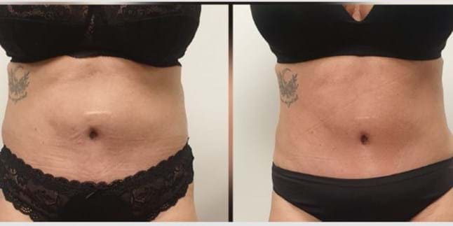 Lymphodrainage brésilien avant et après photo