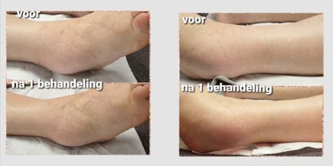 Lymphodrainage avant et après photo