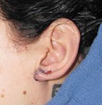 After Earlobe Surgery