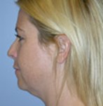 Before Double Chin Liposculpture