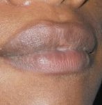 After Lip Correction