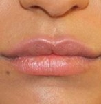 After Lip Enlargement with Own Fat