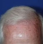 After Hair Transplantation