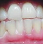 After Bleaching Teeth