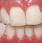 After Dental Bleaching