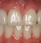 After Dental Implants