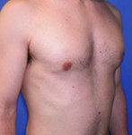 After Gynecomastia