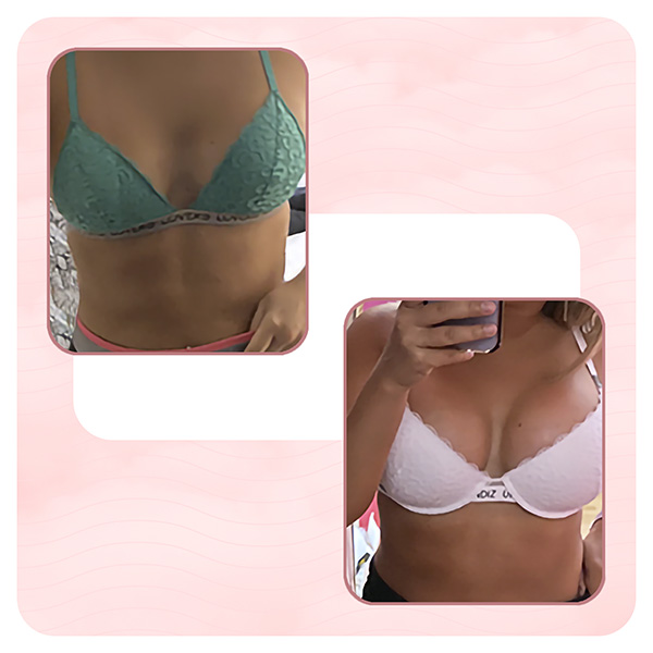 Breast enlargement experience of M.C. Wellness Kliniek