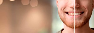 Dents blanches - blanchiment des dents
