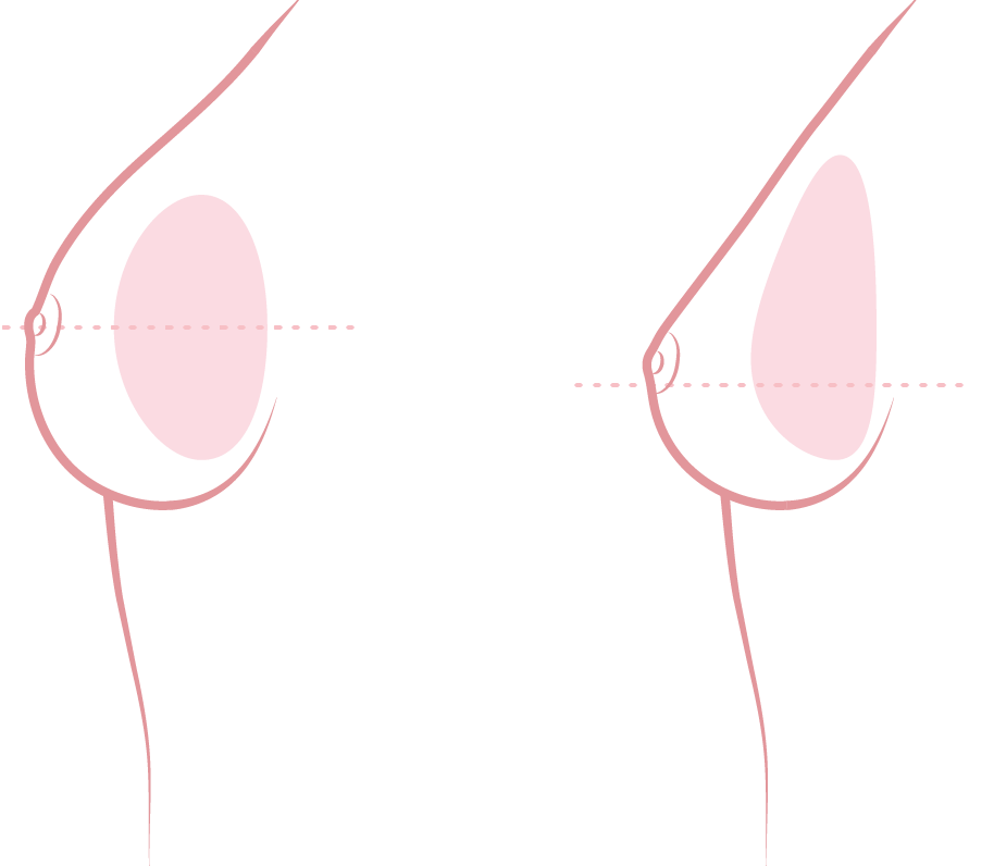 Anatomical implants or round prosthesis behind muscle