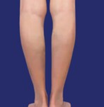 Image of rejuvenated legs without veins after the procedure